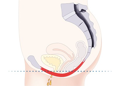 Pelvic-Floor Muscle Repair 5 Pelvic floor muscles East Bridgford