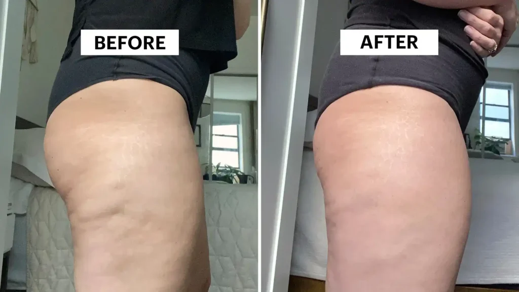 Sculpting Your Bum: Can Toning Exercises Really Reduce Cellulite? 1 Do Toning Exercise East Bridgford Really Tackle Cellulite?