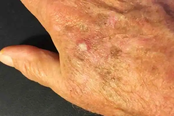 Cryopen For Actinic Keratoses 1 Image of Actinic keratoses East Bridgford on a person hand